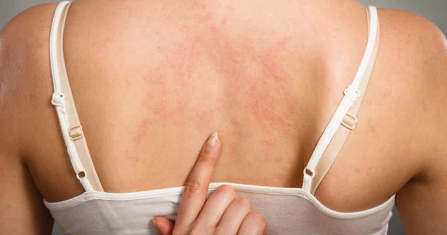 What Does Hepatitis C Rash Look Like：Early Detection, Better Treatment