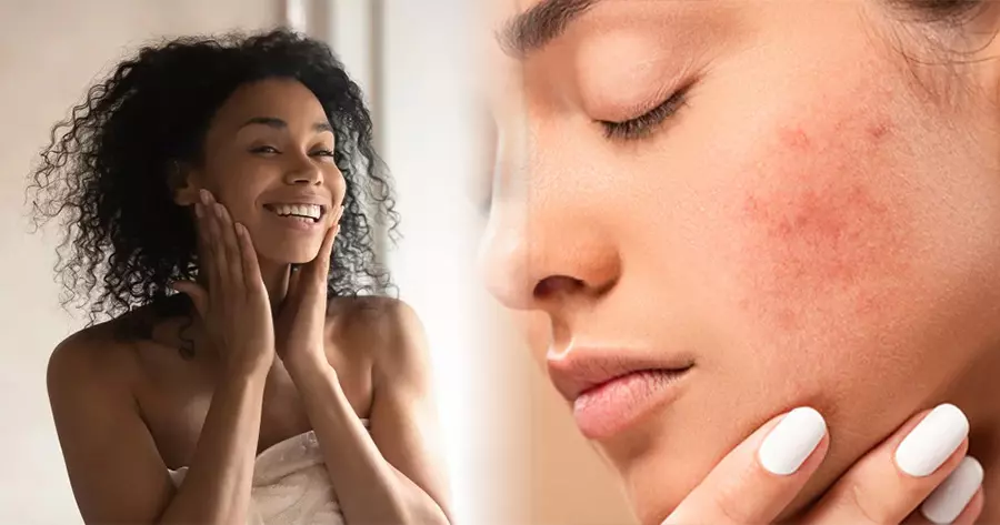What Your Acne Says About You?
