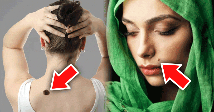 ماذا تقول وحمة الولادة عنك؟