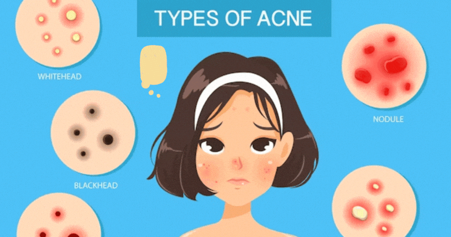 What Type Of Acne Do You Have?