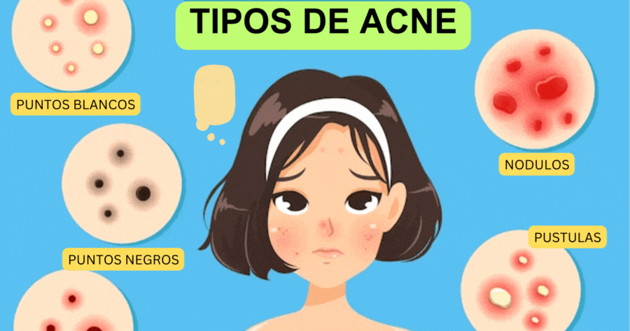 Que Tipo De Acne Voc&ecirc; Tem?