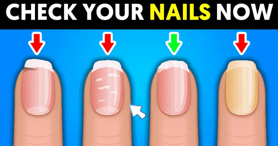 Find Out What Your Nails Are Trying To Warn You About Your Health