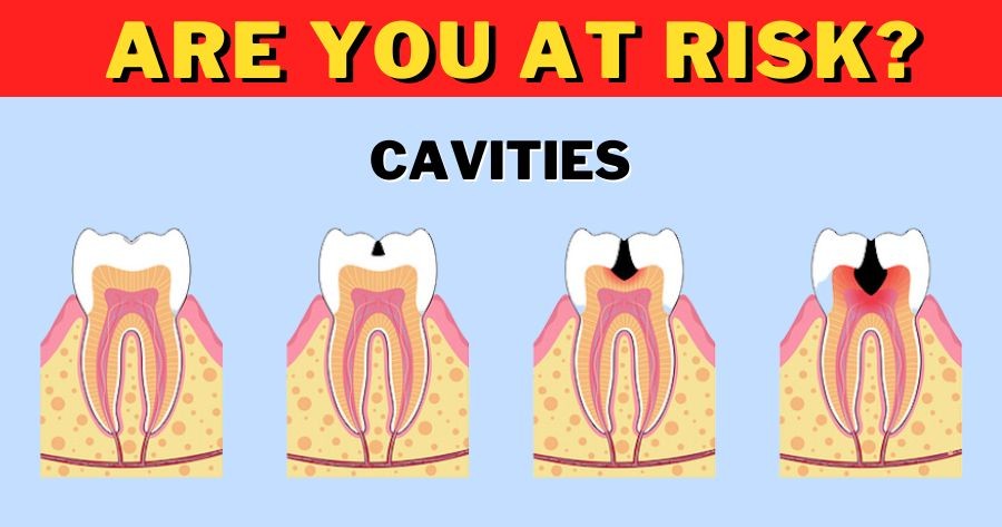The Ultimate Cavities Quiz | Are You At Risk?