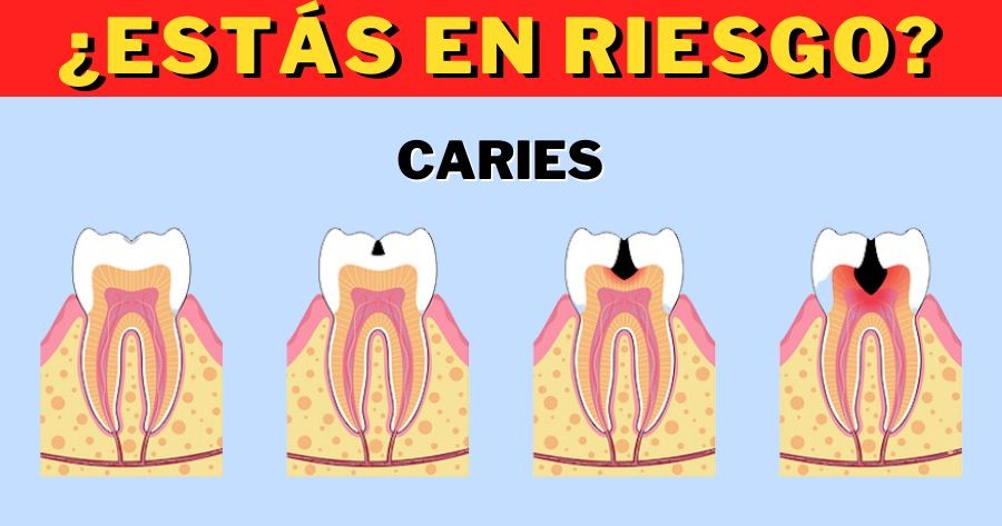 Quiz Definitivo Sobre C&aacute;ries | Voc&ecirc; Tem Risco De Ter C&aacute;ries?