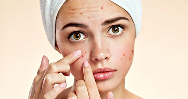 What Does Your Acne Say About Your Personality?